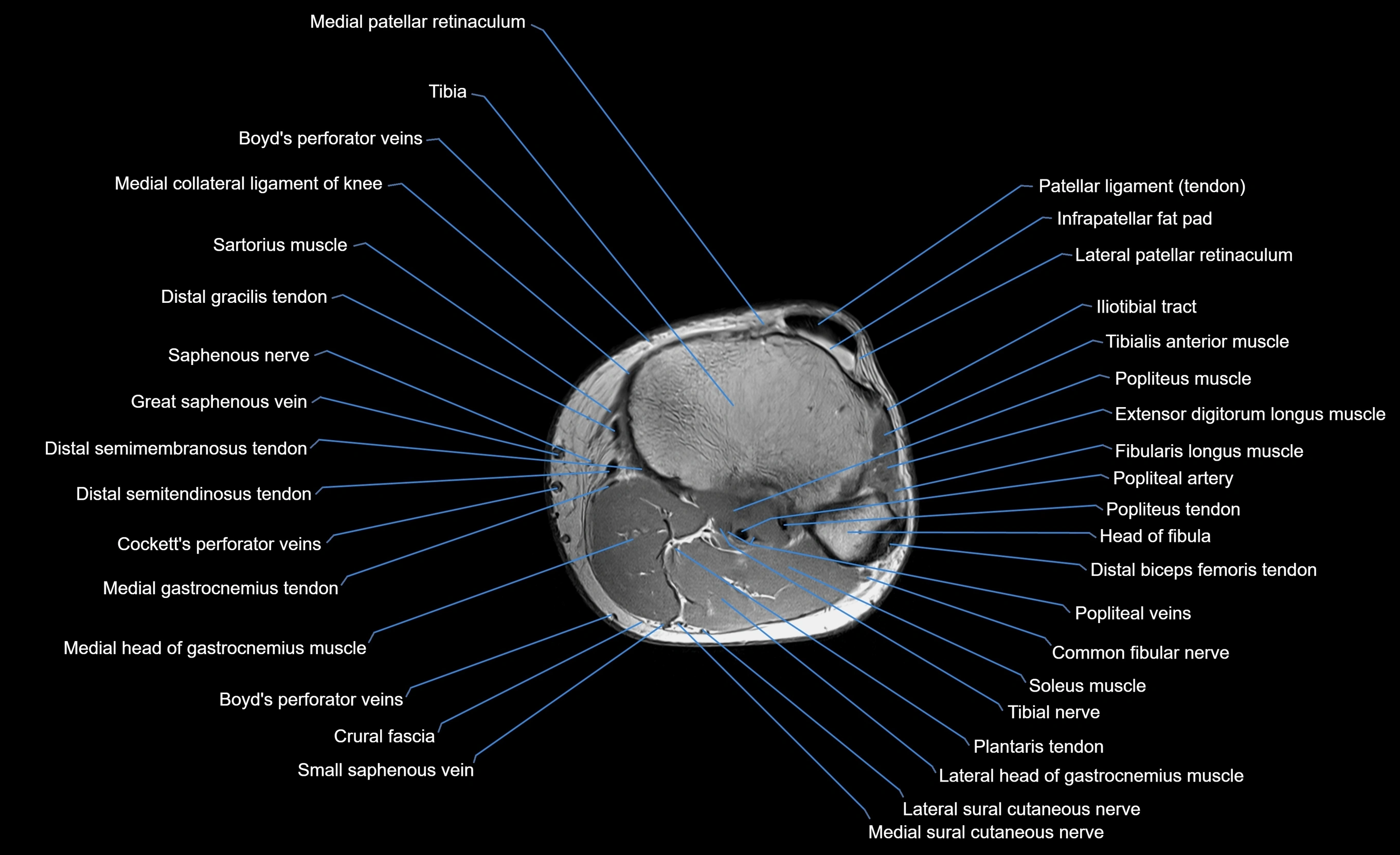 MRI lower leg axial cross sectional anatomy 3T  radiology  image-img-00001-00021.webp